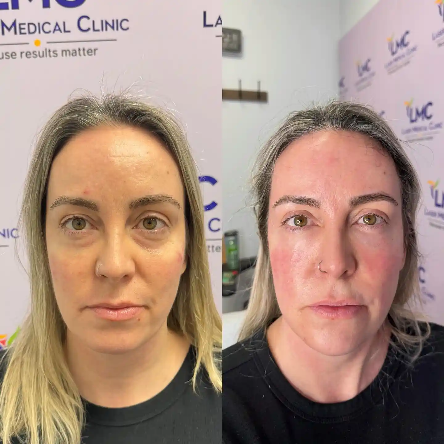 Front-view before-and-after photos of a female patient following NaturaGel PRP Filler facial rejuvenation at LMC