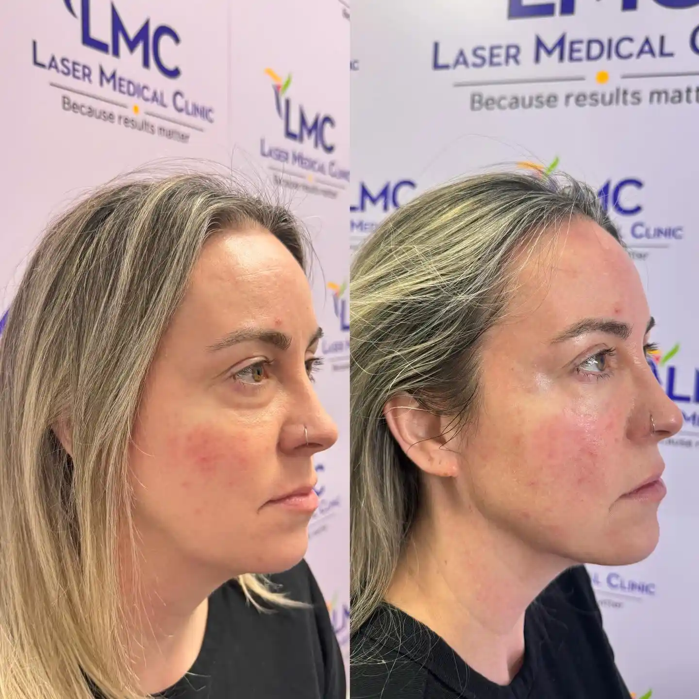 Left-angled before-and-after photos showing a female patient’s NaturaGel PRP Filler facial rejuvenation result at LMC