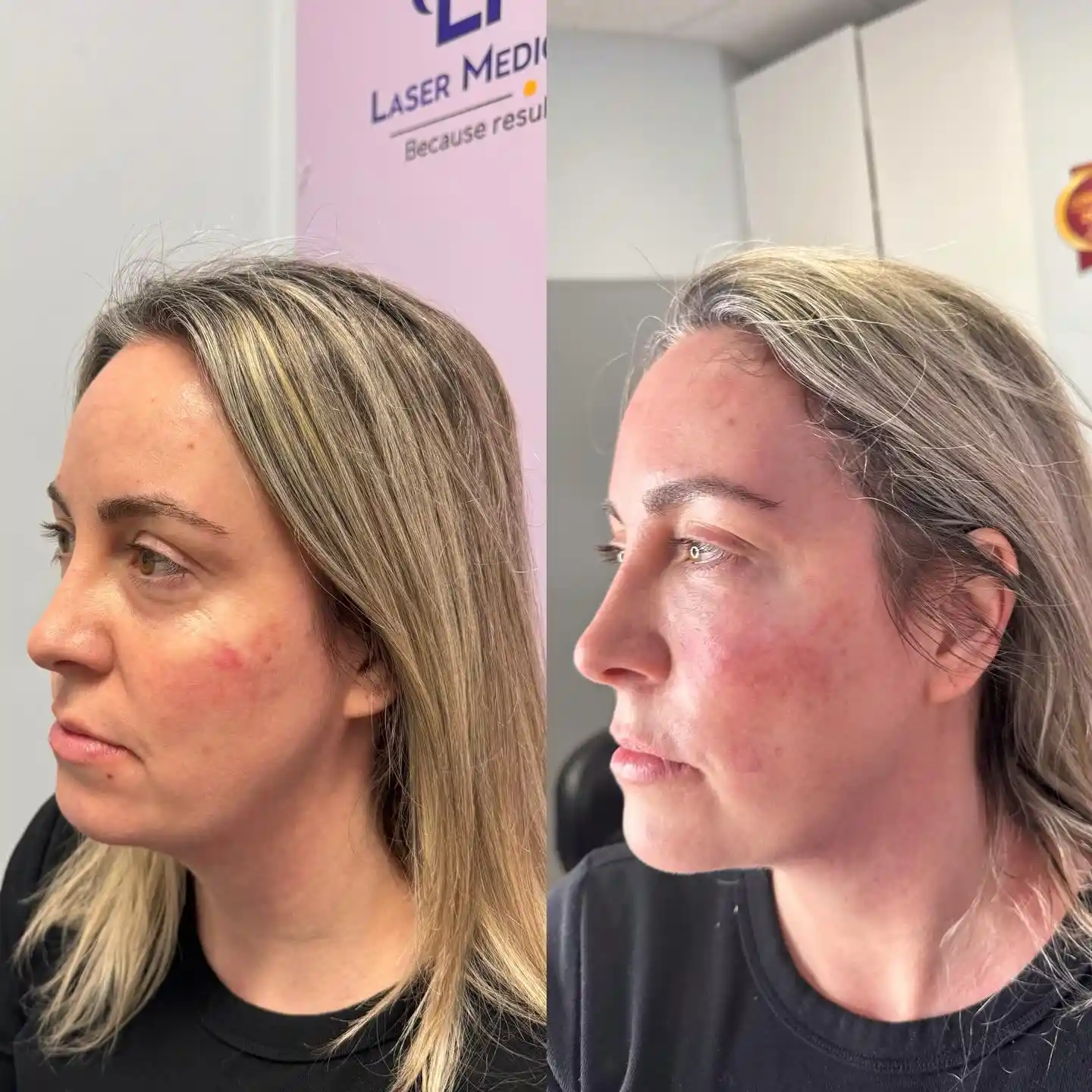 Right-angled before-and-after photos of a female patient treated with NaturaGel PRP Filler for natural facial rejuvenation