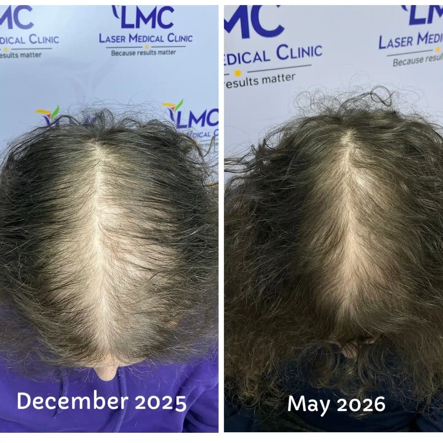 Female pattern hair loss before and after PRP hair restoration in Toronto