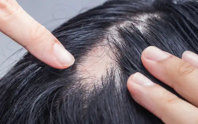 Woman reviewing progressive hair thinning during a hair-restoration consultation