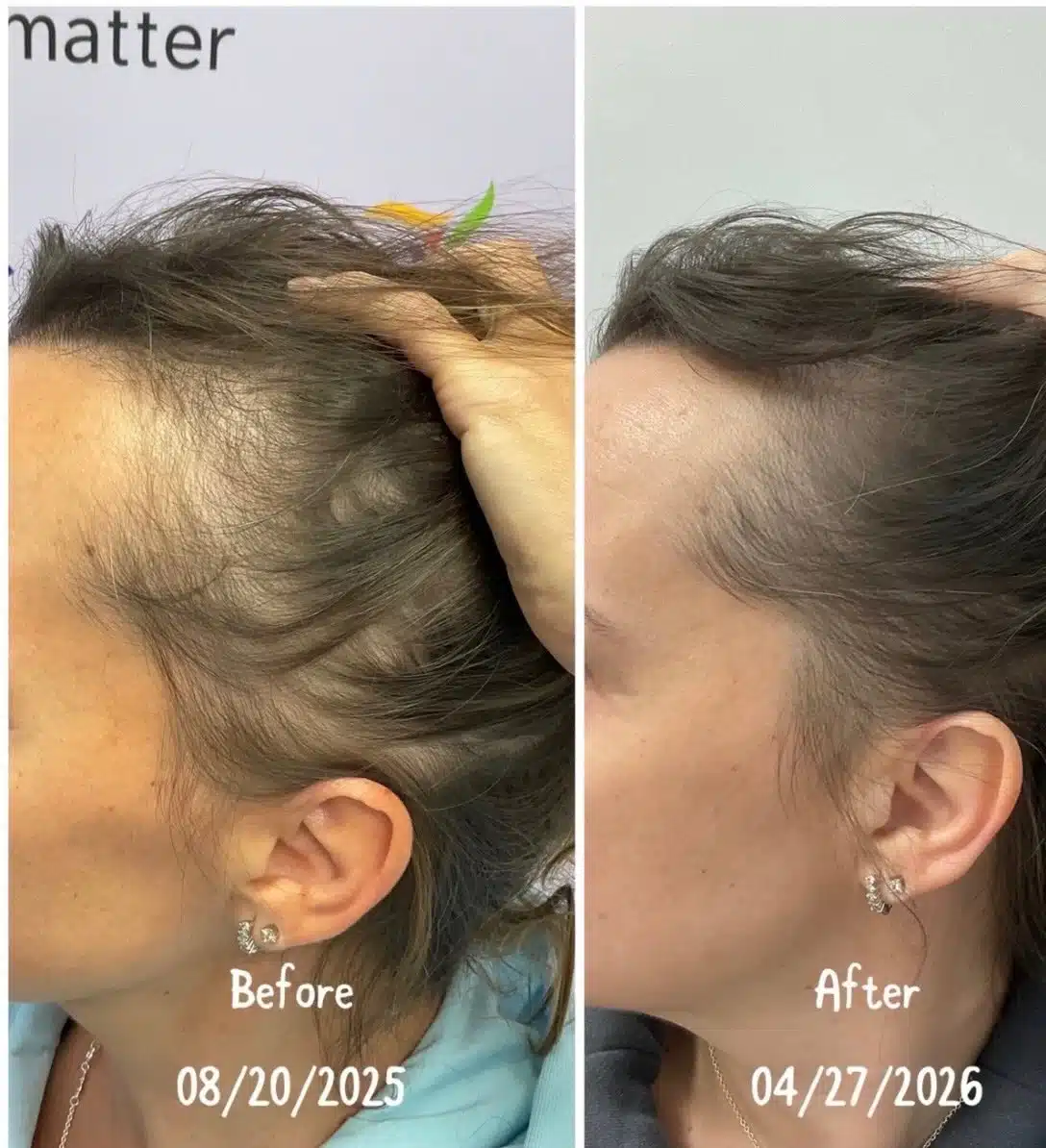 Female temple hair regrowth before and after PRP hair treatment in Toronto