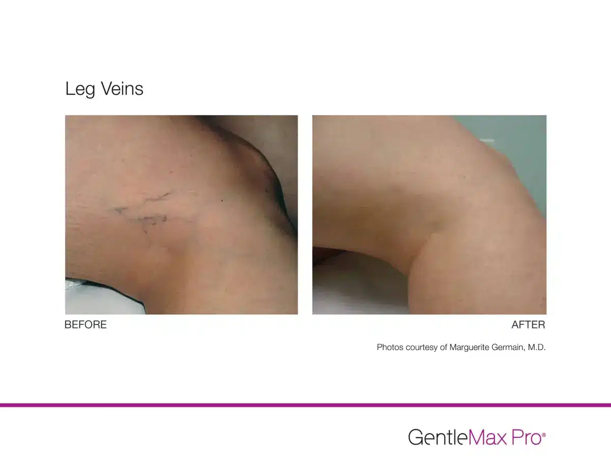 Leg vein removal before and after using GentleMax Pro laser