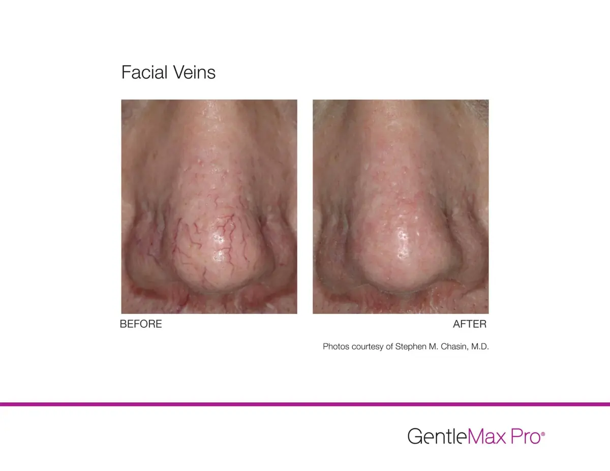 Nose and facial vein removal before and after using GentleMax Pro laser