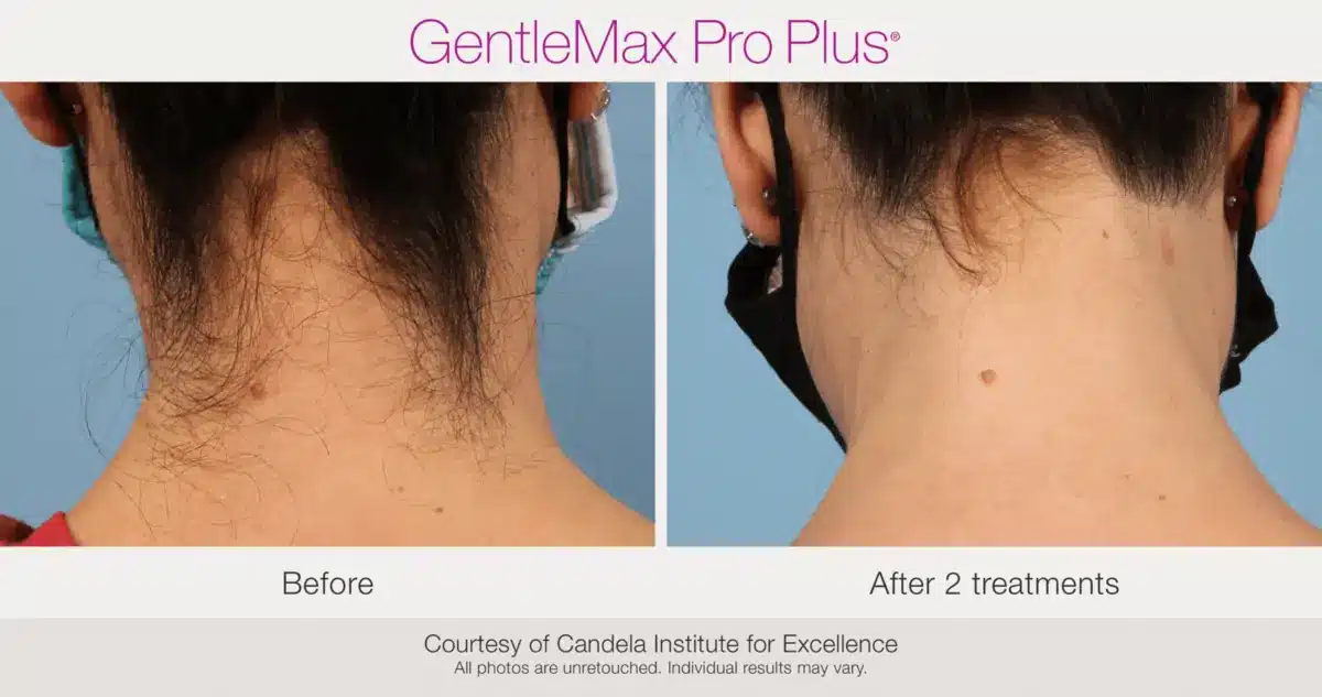 Back-of-neck laser hair removal before and after using GentleMax Pro Plus