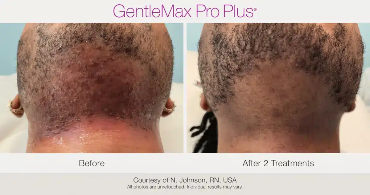 Chin ingrown hair treatment before and after using GentleMax Pro Plus laser