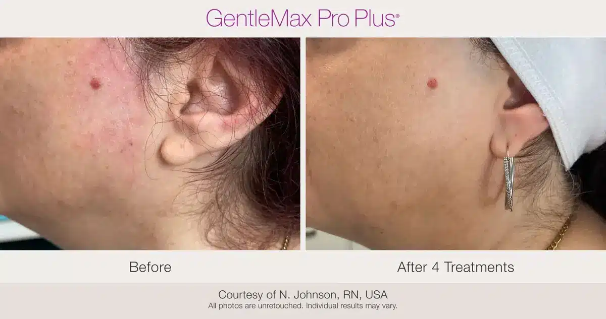 Facial redness treatment before and after using GentleMax Pro Plus laser in Toronto