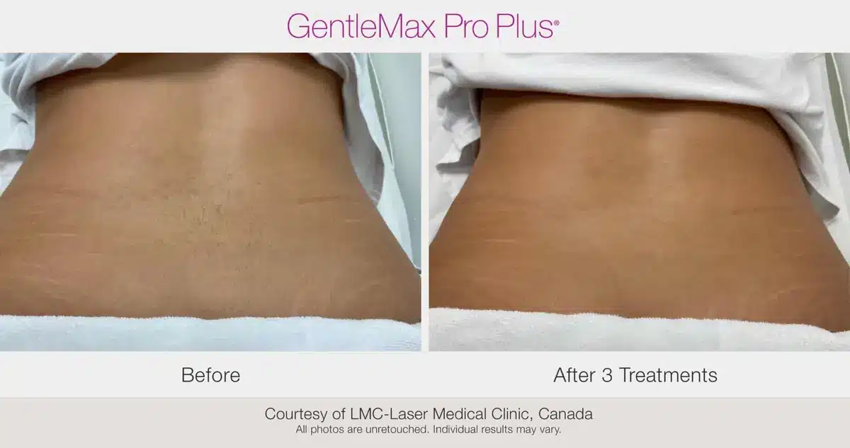 Female lower-back laser hair removal before and after using GentleMax Pro Plus