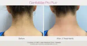 Gentlemax Pro Plus Female Neckline Laser Hair Removal Before After