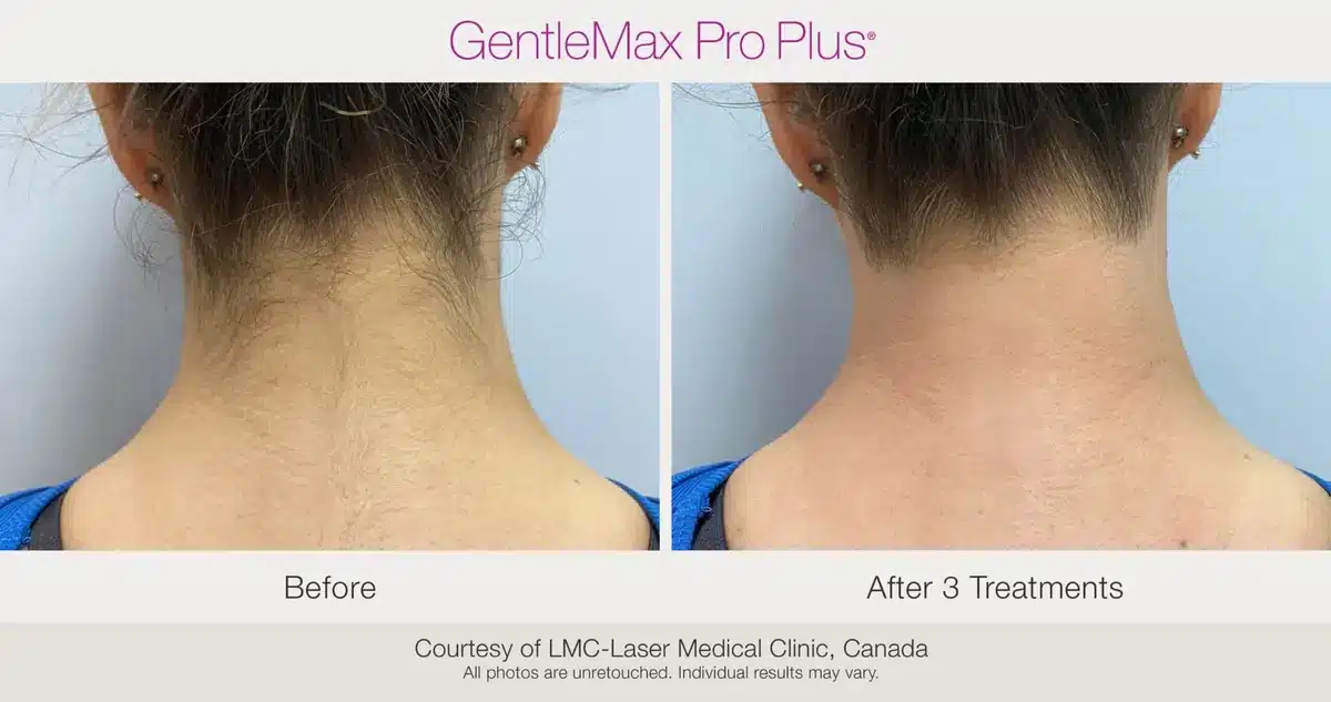 GentleMax Pro Plus female neckline laser hair removal before and after result in Toronto