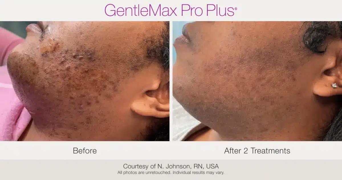 Jawline ingrown hair treatment before and after using GentleMax Pro Plus laser