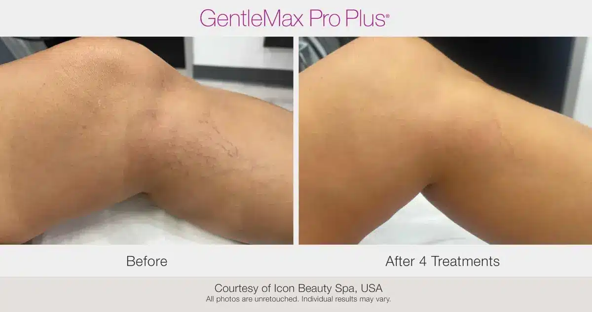 Knee spider vein treatment before and after using GentleMax Pro Plus laser