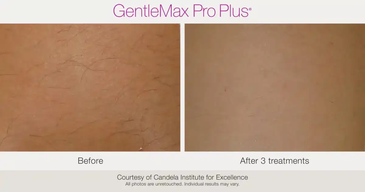 GentleMax Pro Plus laser hair removal before and after treatment results