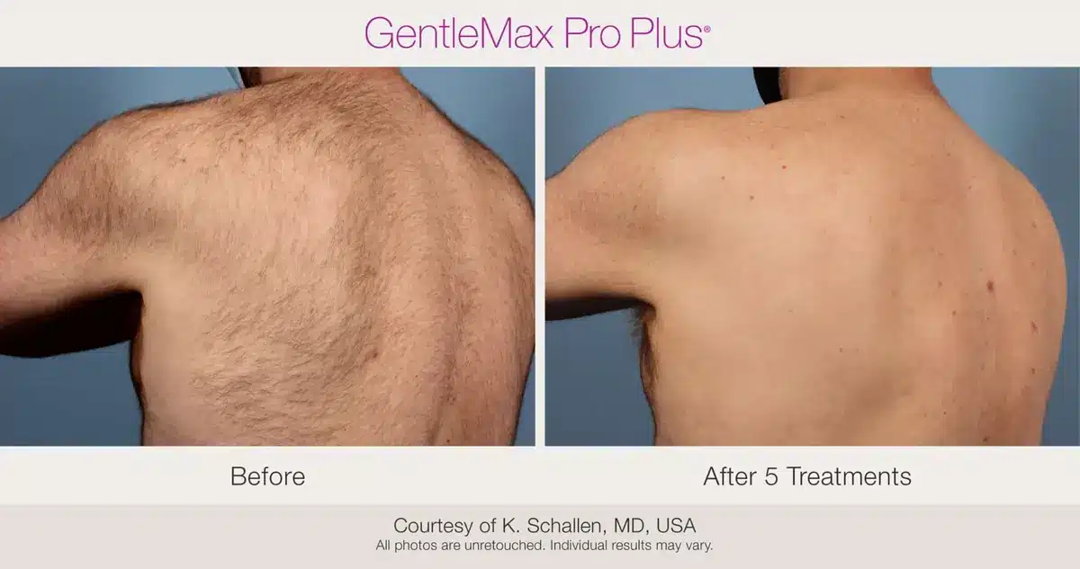 Male back laser hair removal before and after using GentleMax Pro Plus