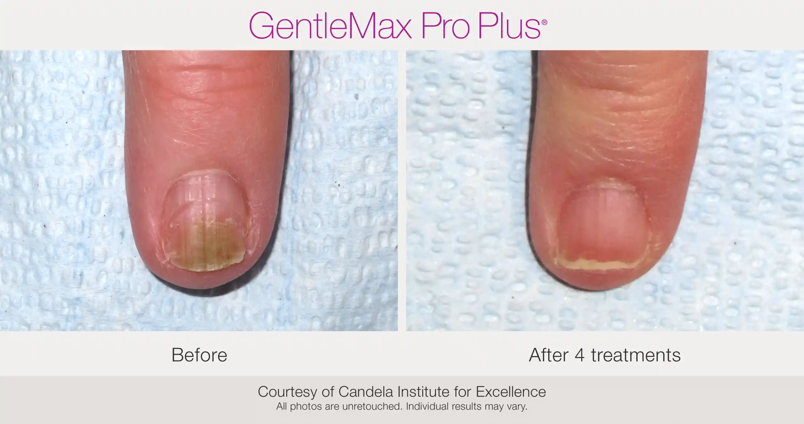 Before and after four GentleMax Pro Plus laser treatments for fingernail fungus