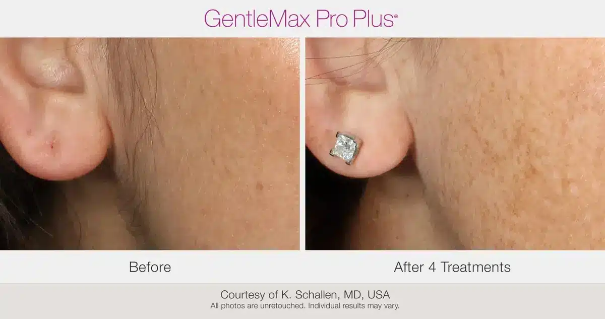 Sideburn laser hair removal before and after using GentleMax Pro Plus
