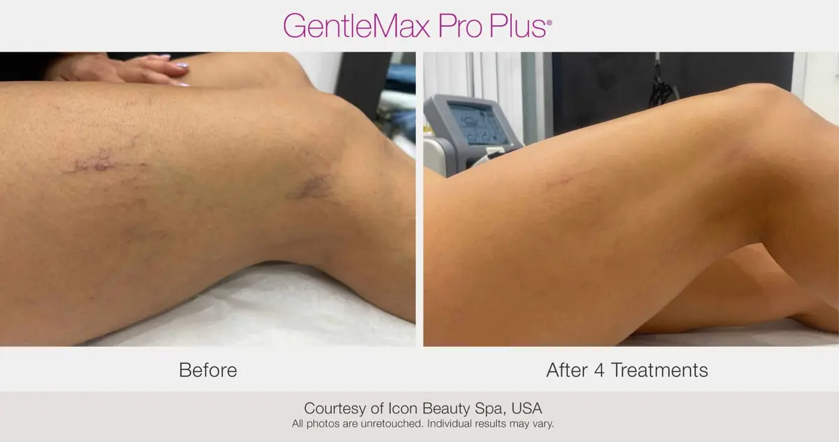 Thigh spider vein treatment before and after using GentleMax Pro Plus laser