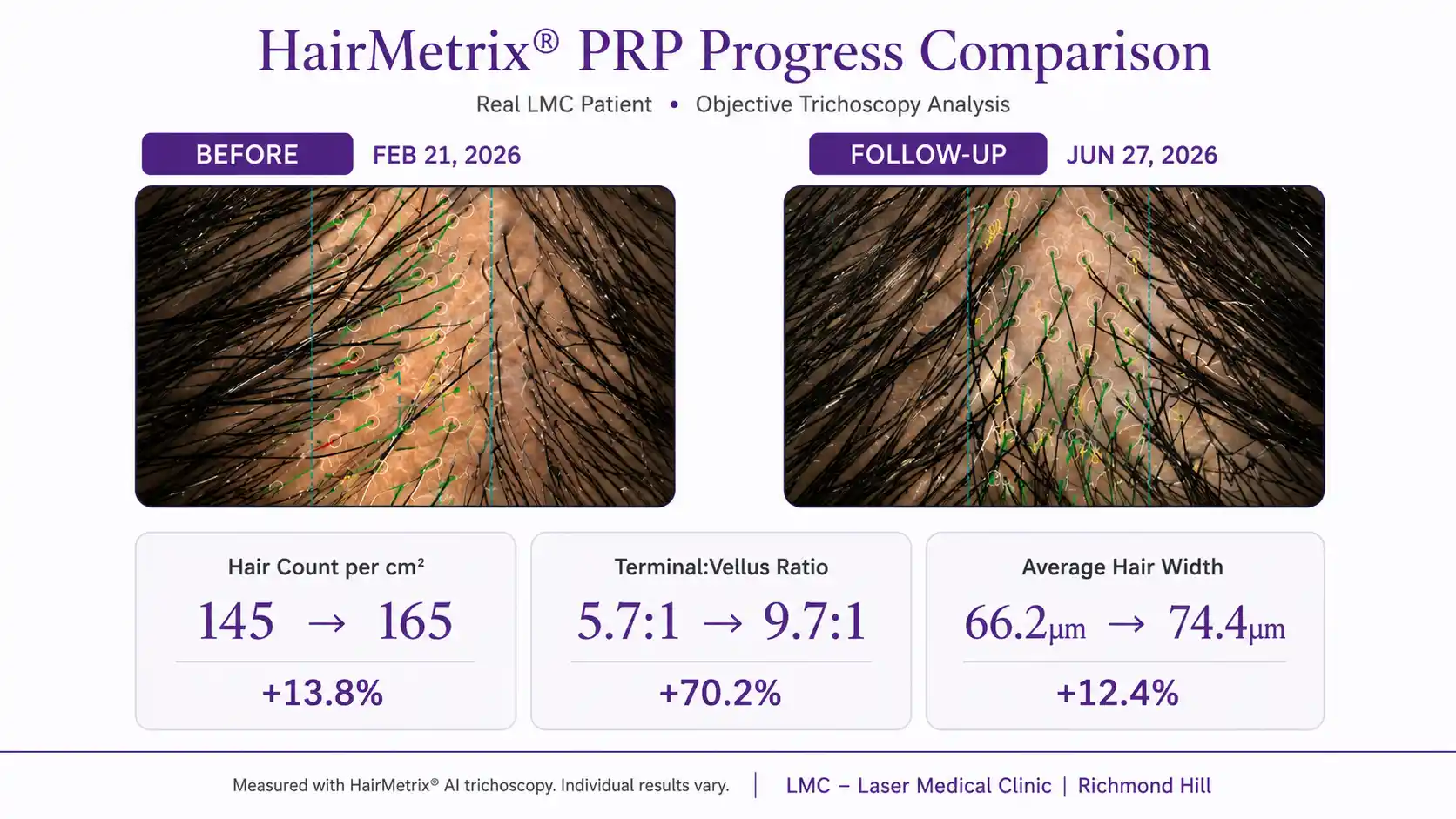 HairMetrix PRP hair growth comparison showing increased hair count, improved terminal-to-vellus ratio and greater hair width at LMC in Richmond Hill