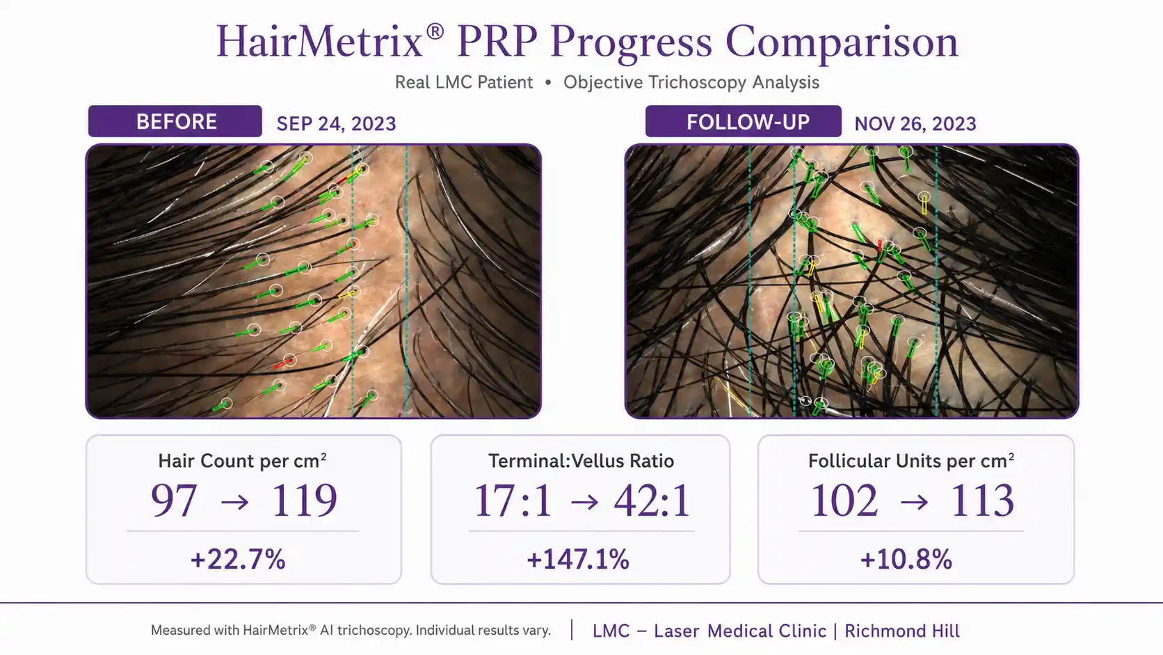 HairMetrix PRP hair-restoration progress comparison showing changes in hair count and terminal-to-vellus ratio