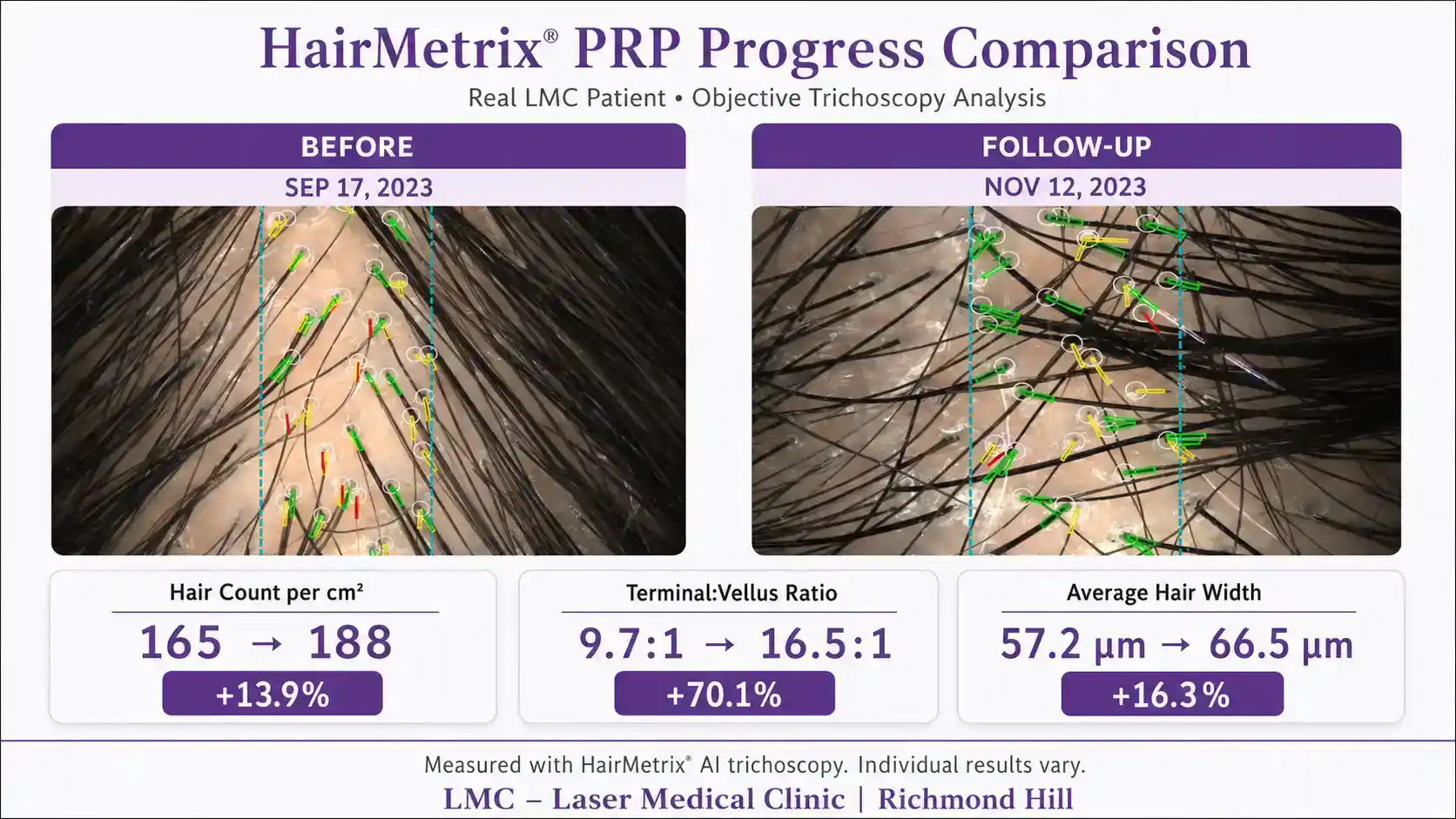 HairMetrix analysis showing PRP hair restoration progress for Client 02 at LMC Laser Medical Clinic in Richmond Hill