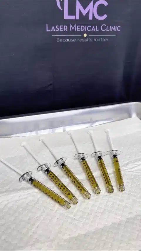 Prepared PRP and PRF hair-restoration systems available at LMC