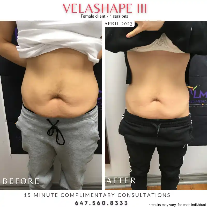 VelaShape III abdomen skin tightening before and after four treatments at LMC in Toronto