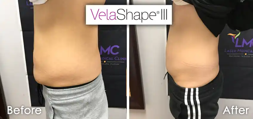 Side-view VelaShape III abdomen contouring and skin tightening before and after at LMC