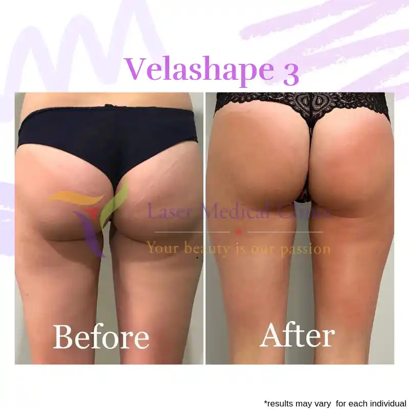 VelaShape III buttocks cellulite reduction before and after treatment at LMC
