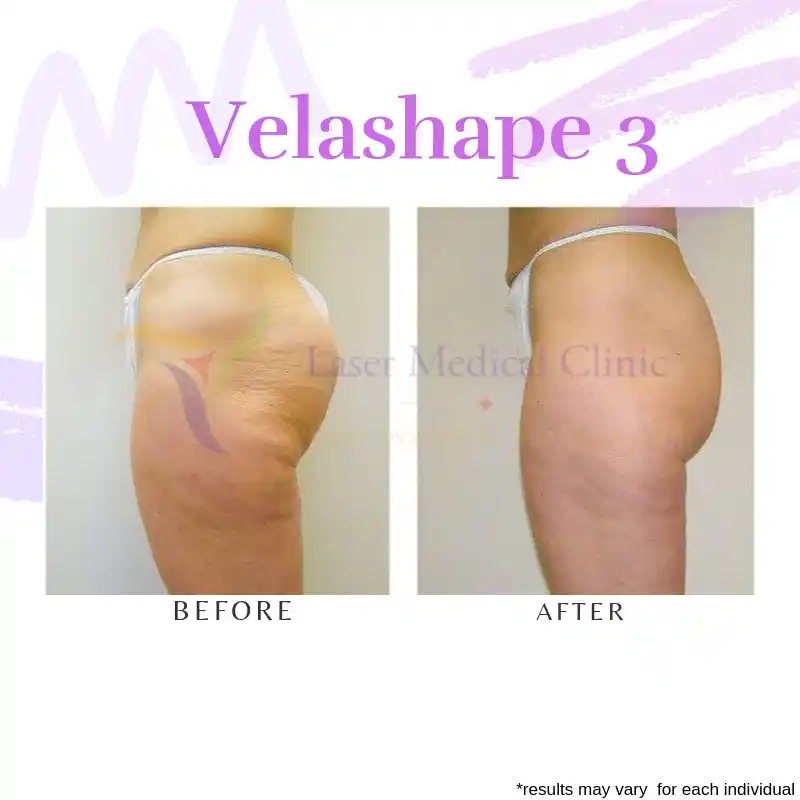 Side-view VelaShape III buttocks and upper-thigh cellulite before and after treatment