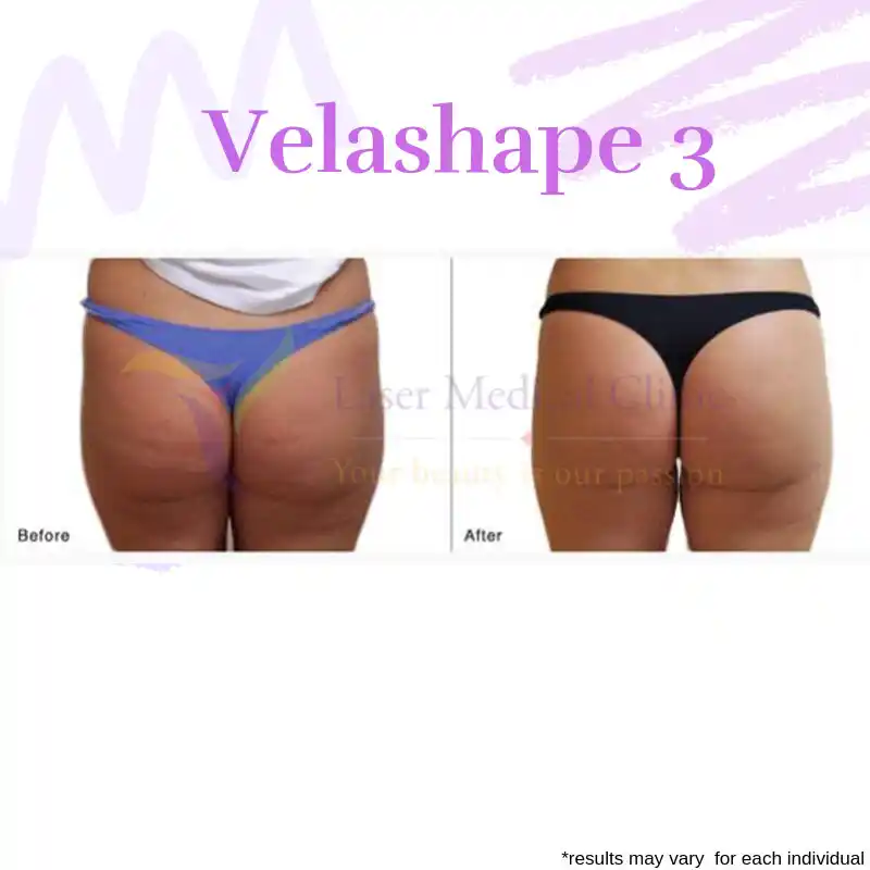 VelaShape III thigh cellulite reduction before and after treatment at LMC
