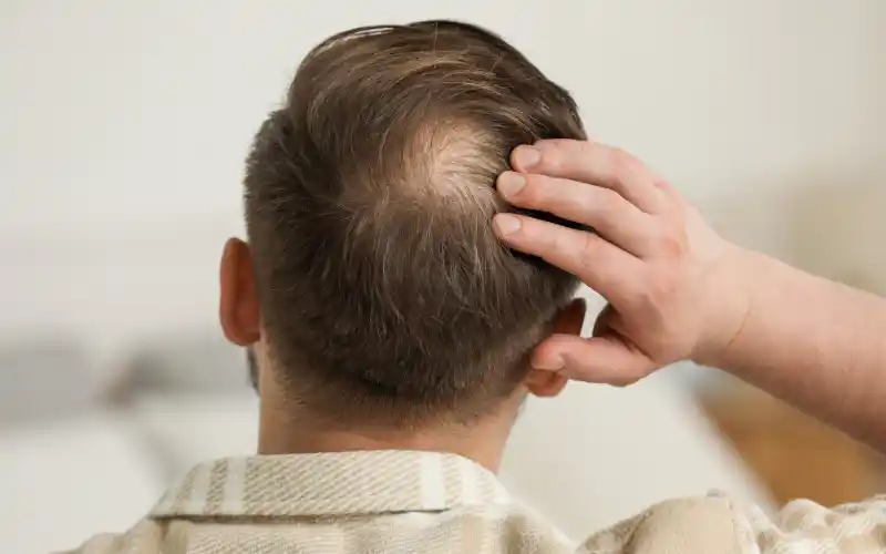 Man seeking an assessment for early hairline and crown thinning