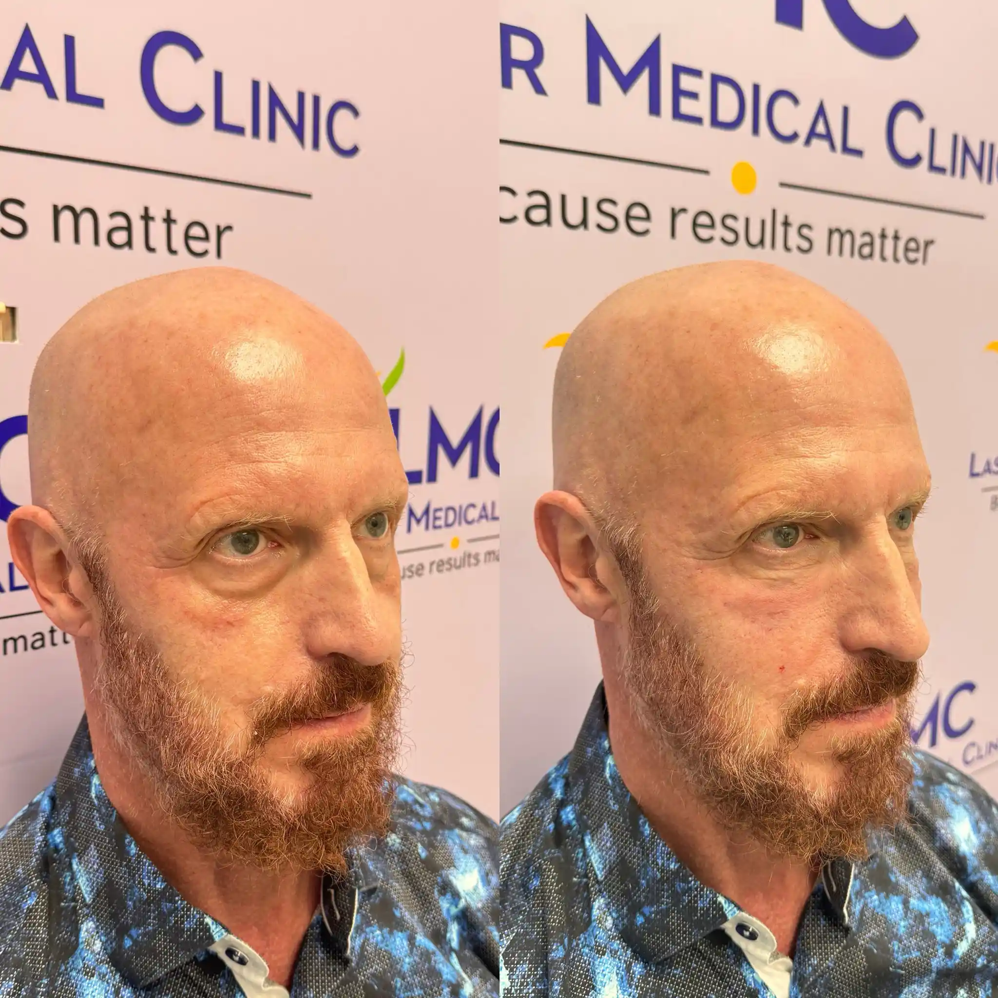 Angled before-and-after photos of a male patient following NaturaGel PRP Filler treatment for under-eye hollows at LMC