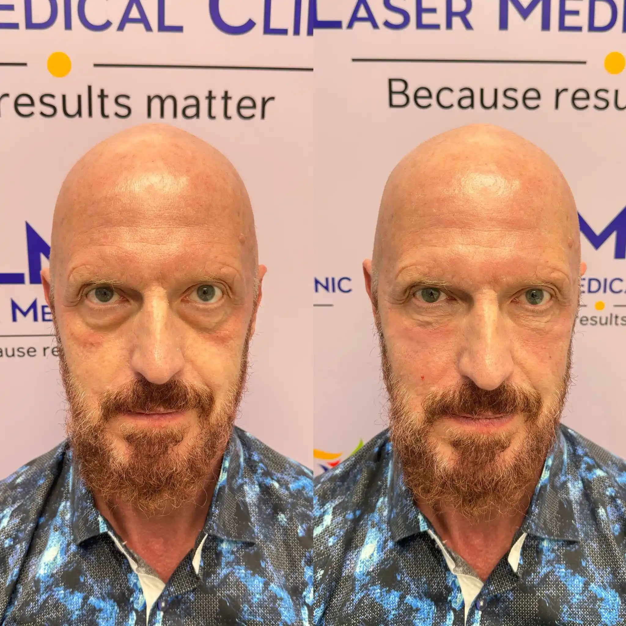 Front-view before-and-after photos of a male patient following NaturaGel PRP Filler treatment under the eyes at LMC