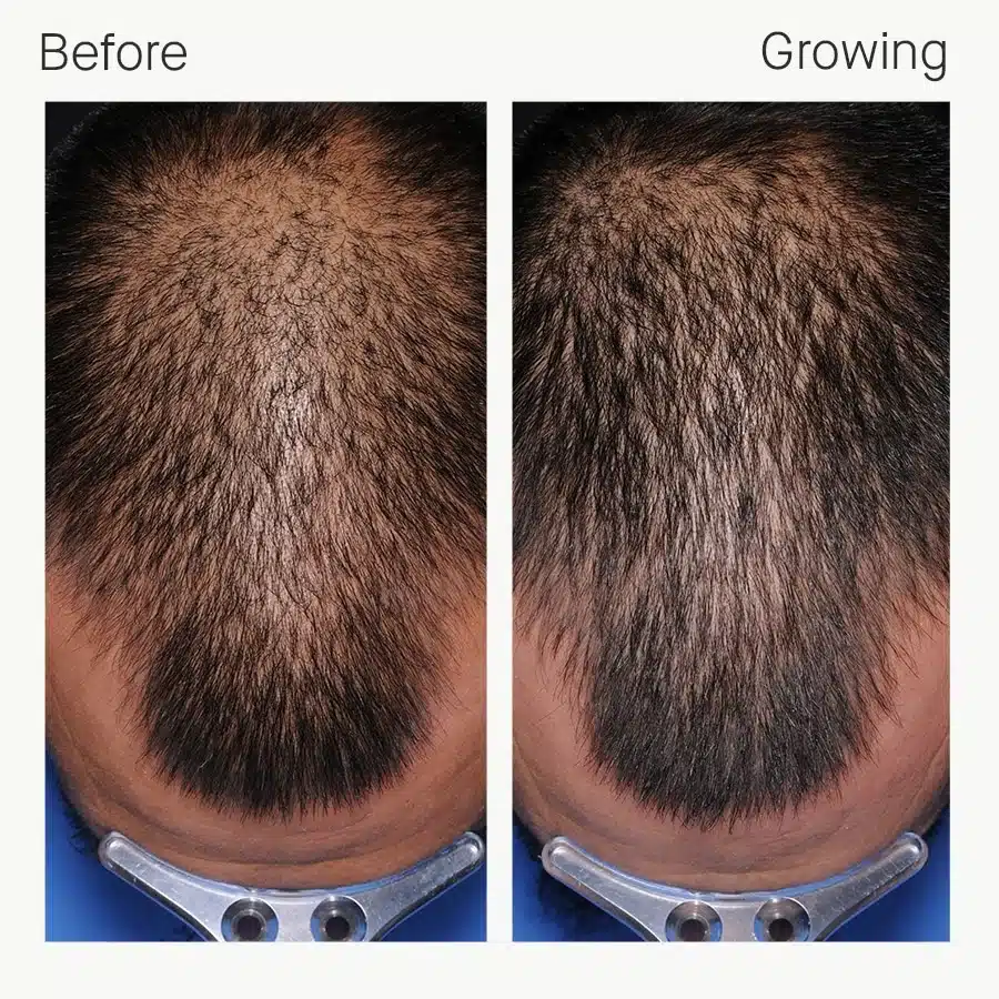Man’s thinning central scalp before and after six months of Nutrafol Men showing improved coverage