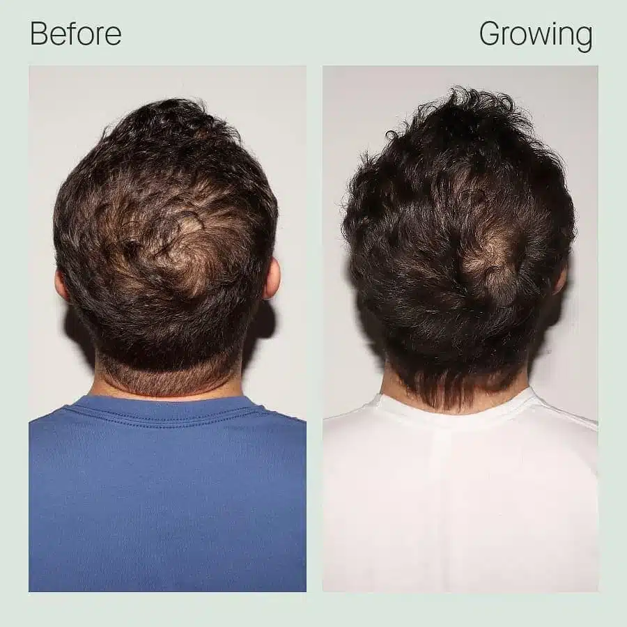 Man’s crown with visible thinning before and after six months of Nutrafol Men