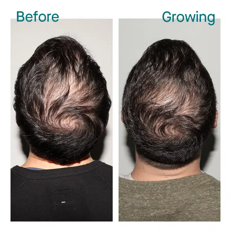 Man’s thinning crown before and after one year of consistent Nutrafol Men use