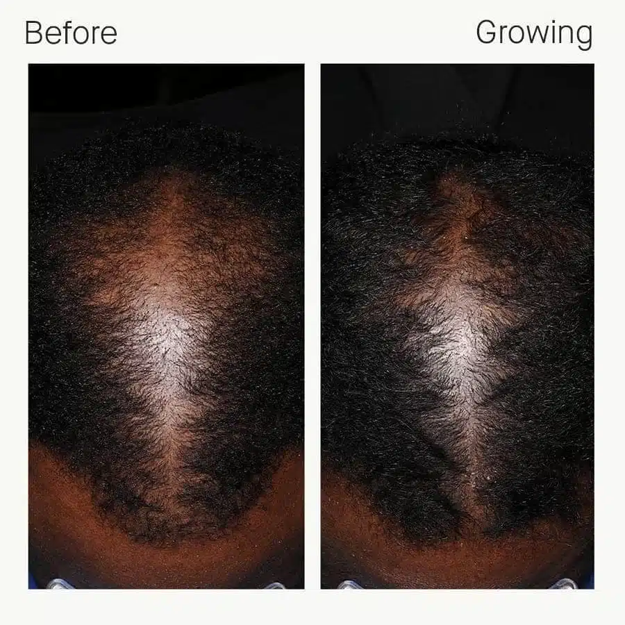 Man’s thinning crown and central scalp before and after three months of Nutrafol Men