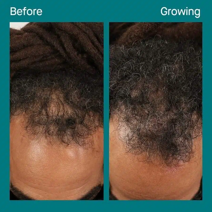 Man’s receding frontal hairline before and after four months of Nutrafol Men