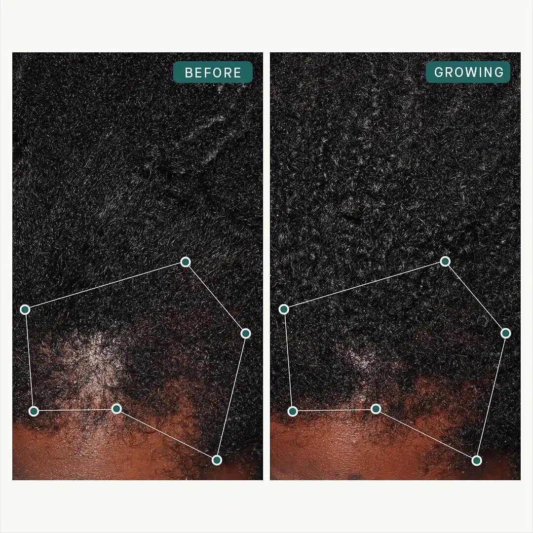 Man with textured hair showing frontal hairline coverage before and after six months of Nutrafol