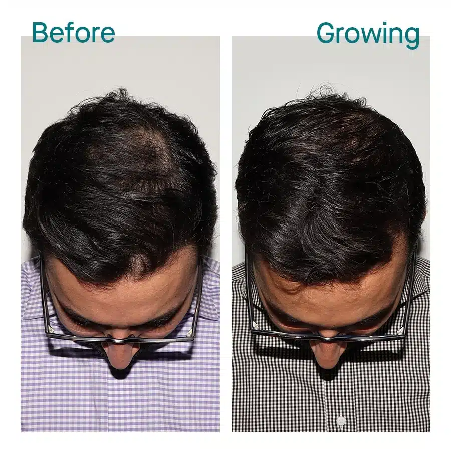 Man’s thinning frontal and top scalp before and after ten months of Nutrafol Men