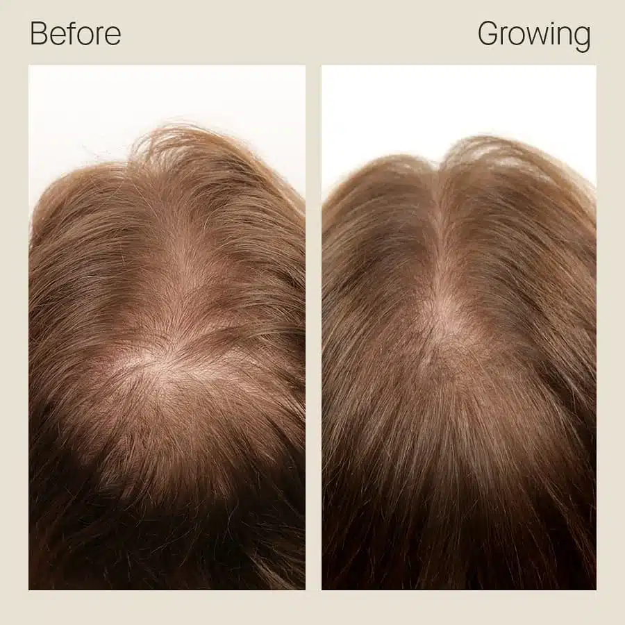 Woman’s thinning crown and widening part before and after four months of Nutrafol