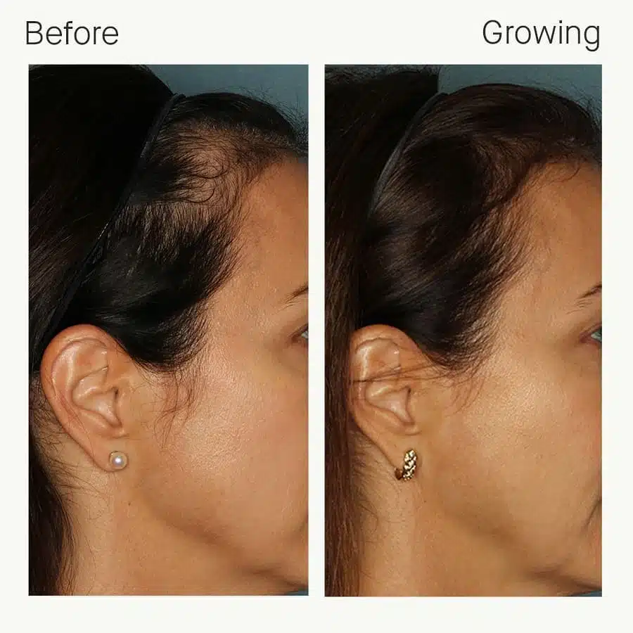 Woman’s front and temple hairline before and after six months of Nutrafol hair growth supplements