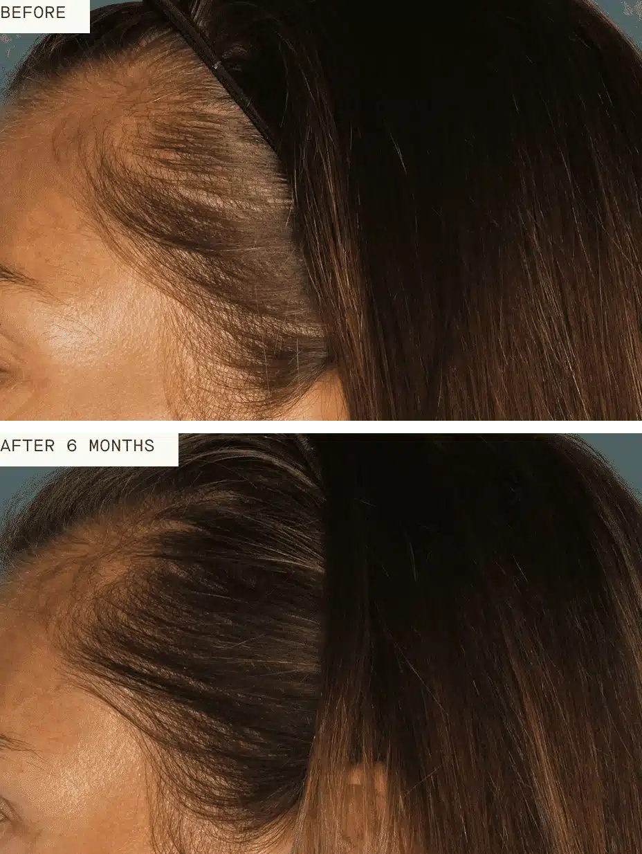 Woman’s temple and hairline before and after six months of Nutrafol showing fuller hair coverage