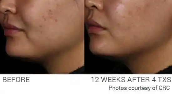 Acne and uneven complexion before and 12 weeks after four PICO Genesis FX treatments