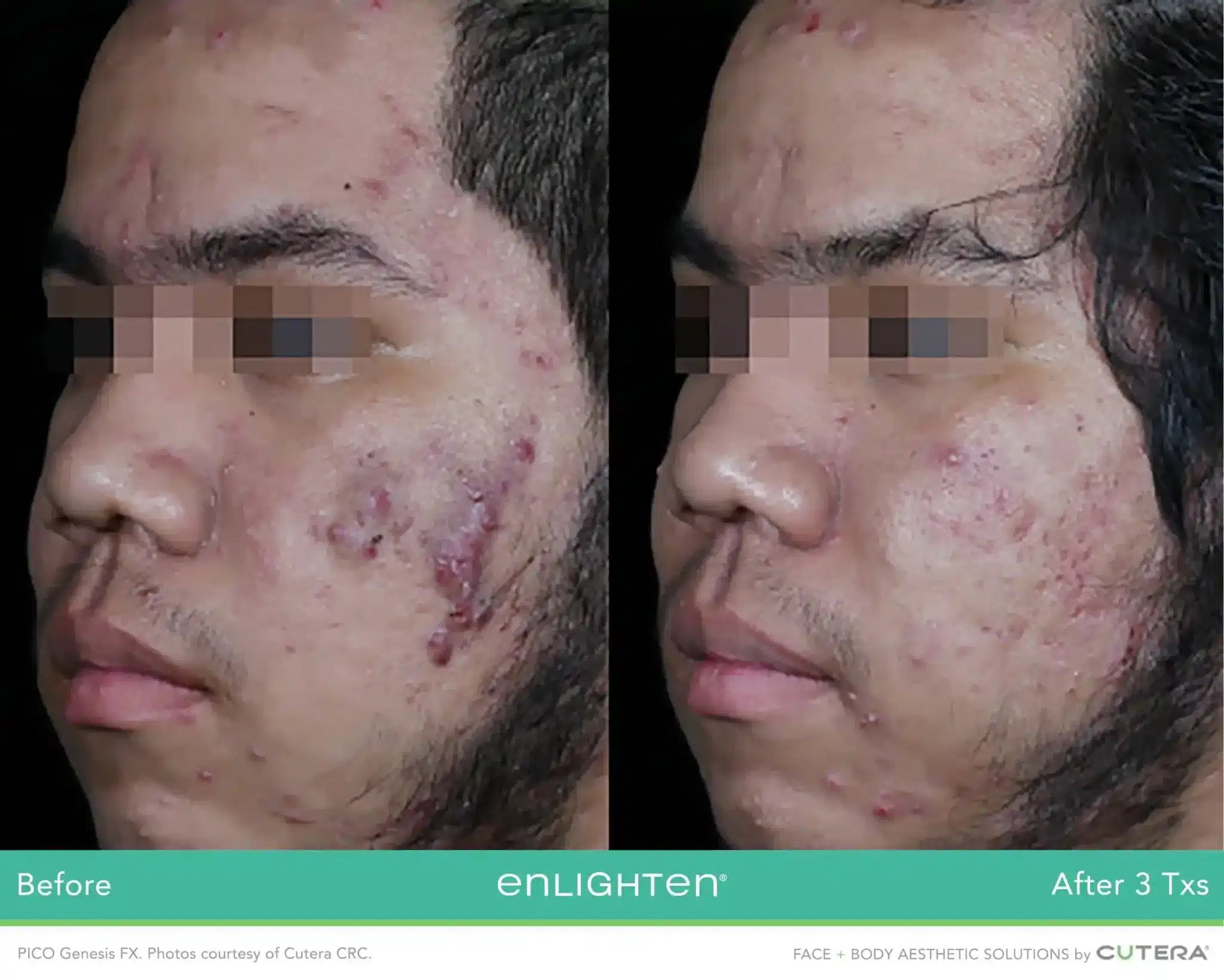 Acne and acne scarring before and after three Cutera PICO Genesis FX treatments