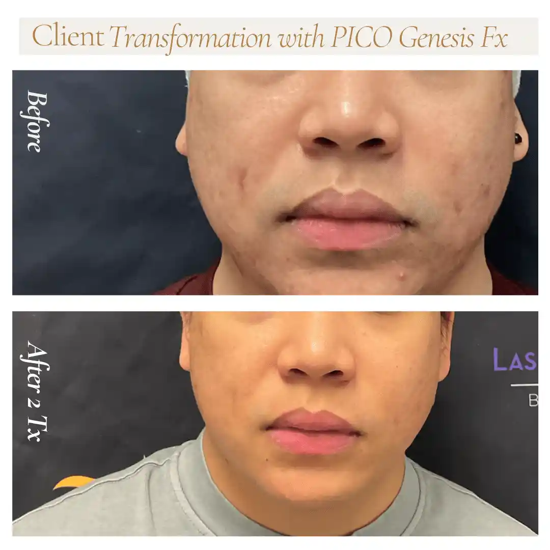 Front-view acne scar improvement after two PICO Genesis FX treatments at LMC Richmond Hill