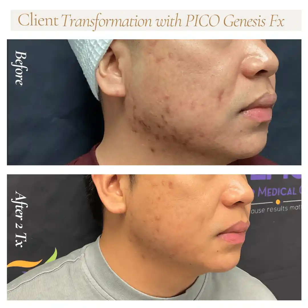 Left-profile acne scar improvement after two PICO Genesis FX treatments at LMC Richmond Hill