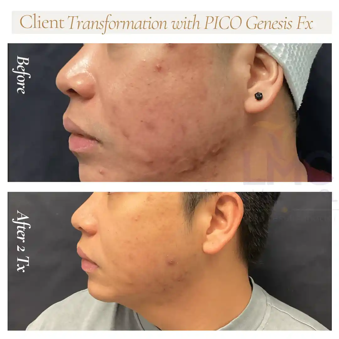 Right-profile acne scar improvement after two PICO Genesis FX treatments at LMC Richmond Hill