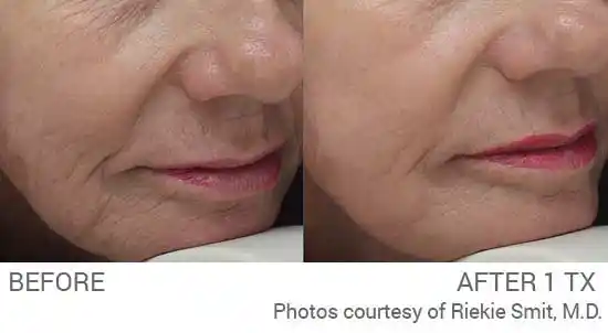Fine lines around the mouth before and after one PICO Genesis FX treatment