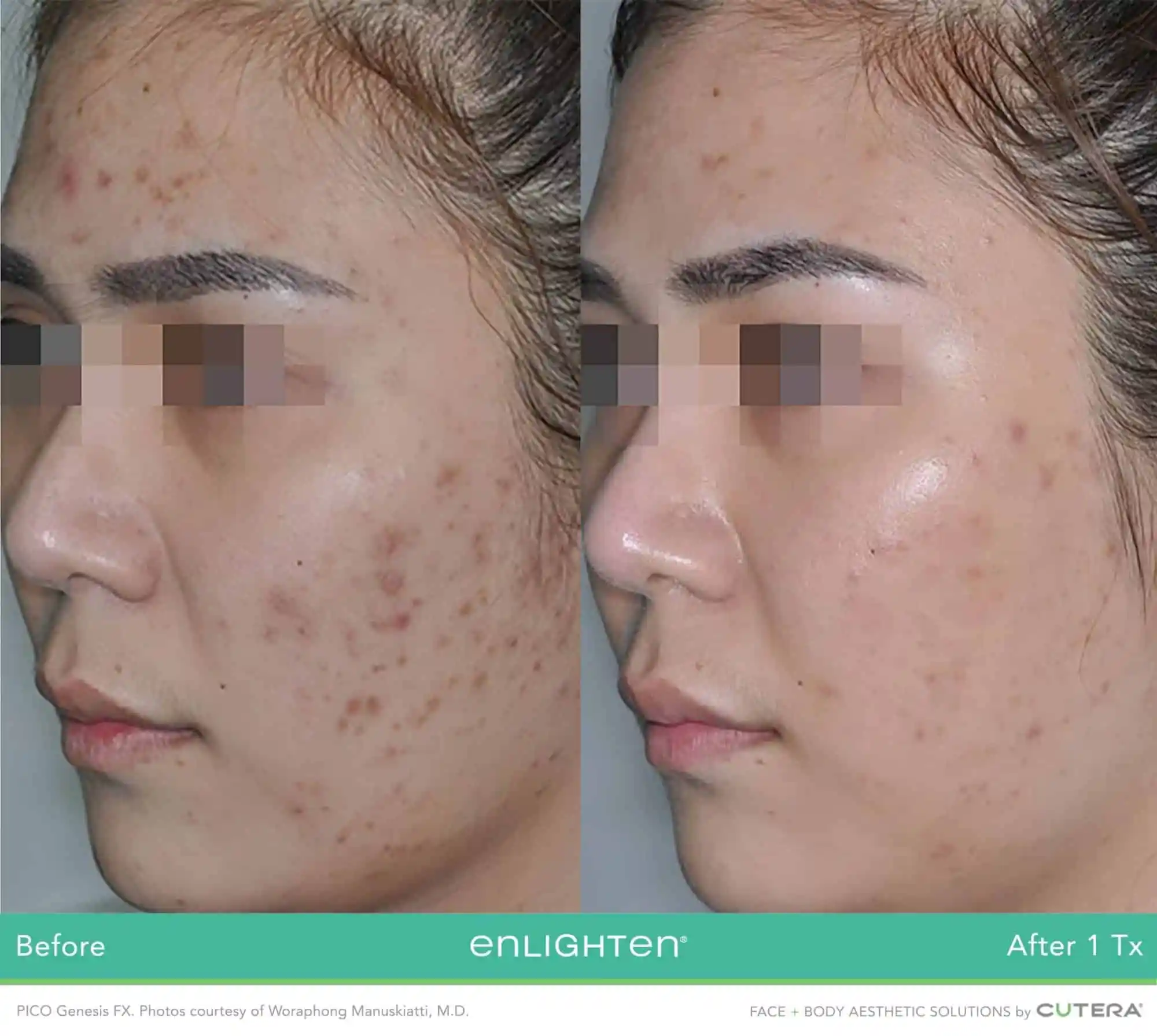 Facial pigmentation and uneven skin tone before and after one PICO Genesis FX treatment